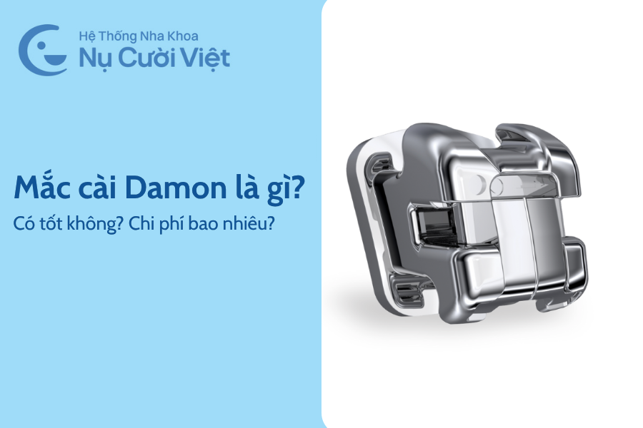 Nụ Cười Việt - NIỀNG RĂNG MẮC CÀI DAMON CÓ TỐT KHÔNG? ƯU ĐIỂM SO VỚI MẮC CÀI TRUYỀN THỐNG?