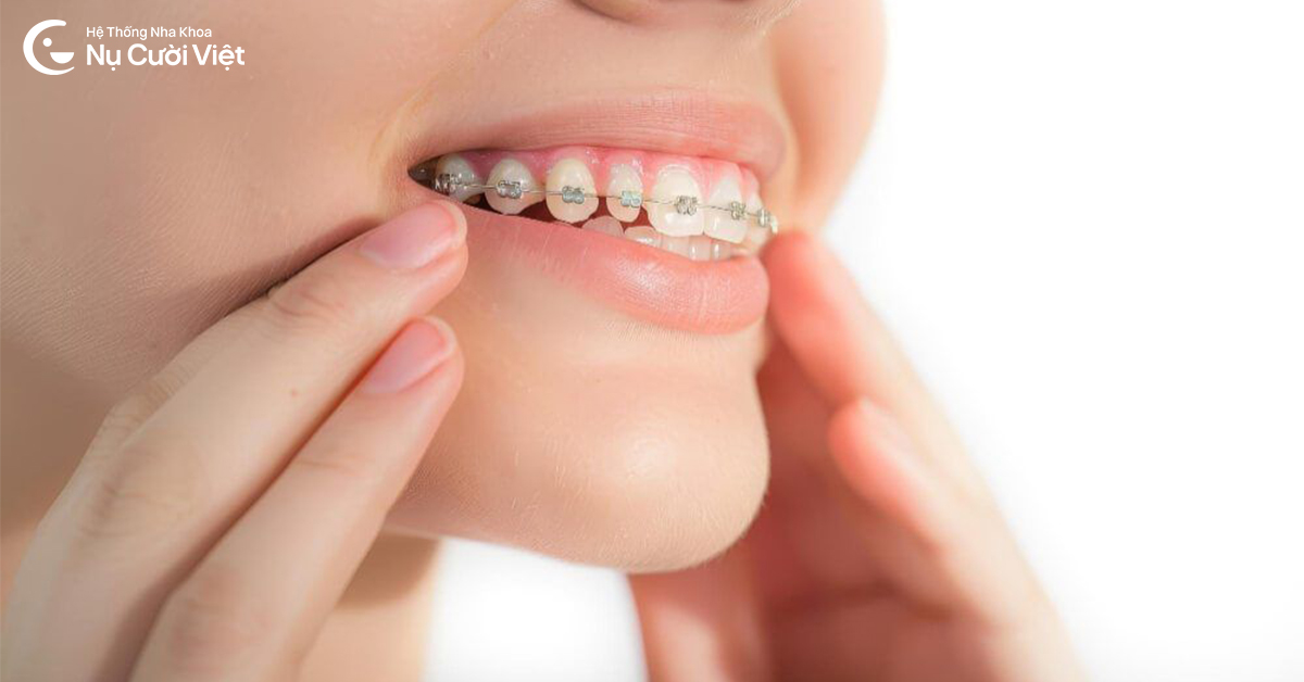 niềng răng mắc cài kim loại mất thời gian bao lâu