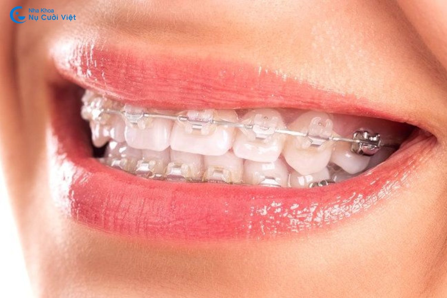 niềng răng mắc cài sứ