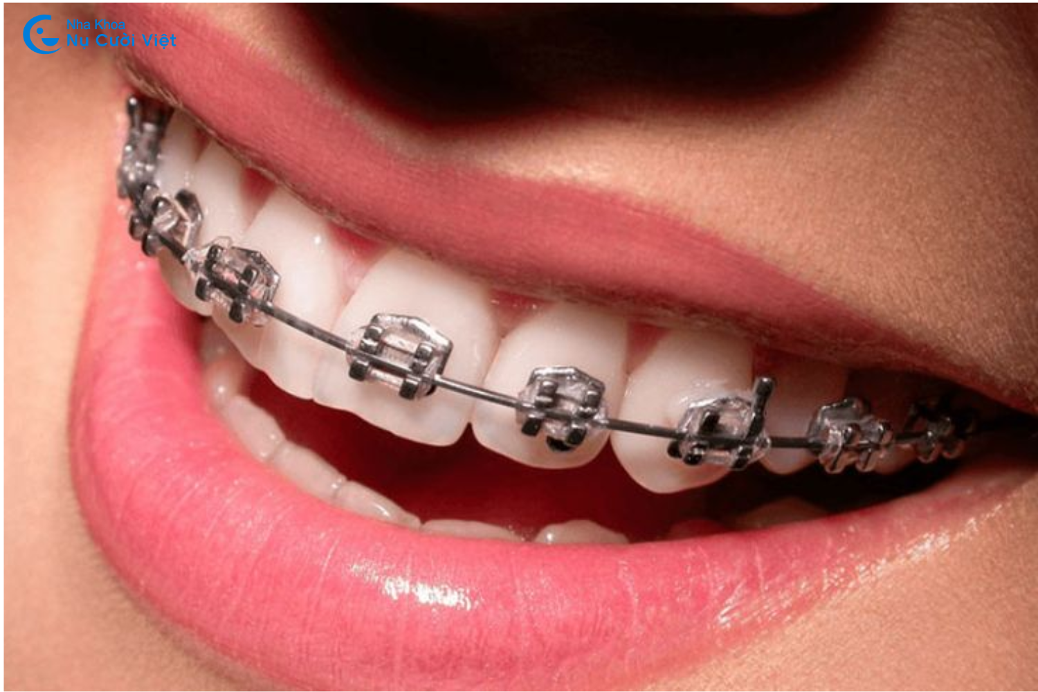 niềng răng mắc cài tự buộc