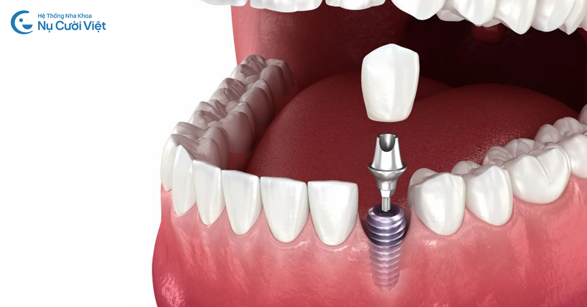 quy trình phục hình răng sứ trên implant