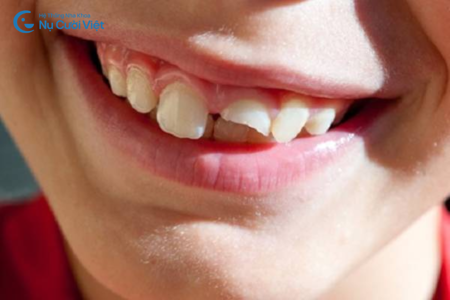 Nụ Cười Việt - Răng bị gãy ngang phải làm sao? Nguyên nhân và cách điều trị 