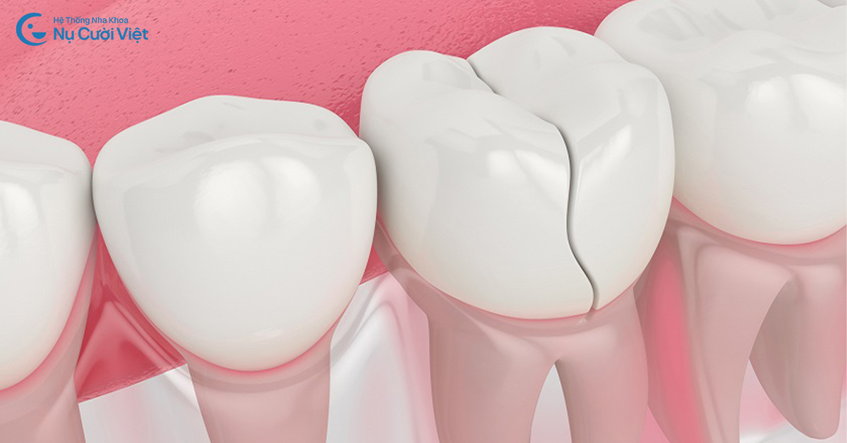 răng bị nứt mẻ