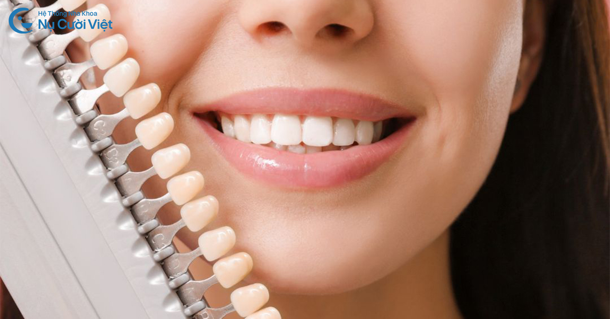 răng khấp khểnh dán sứ veneer có được không