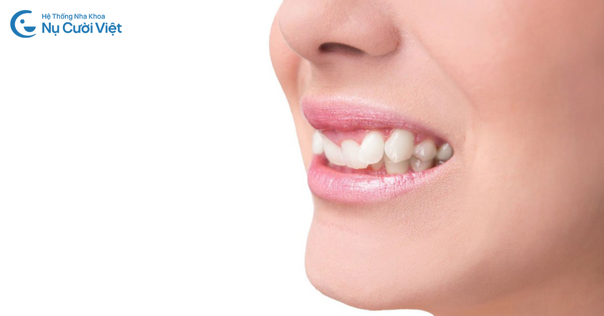răng khấp khểnh là gì và hậu quả
