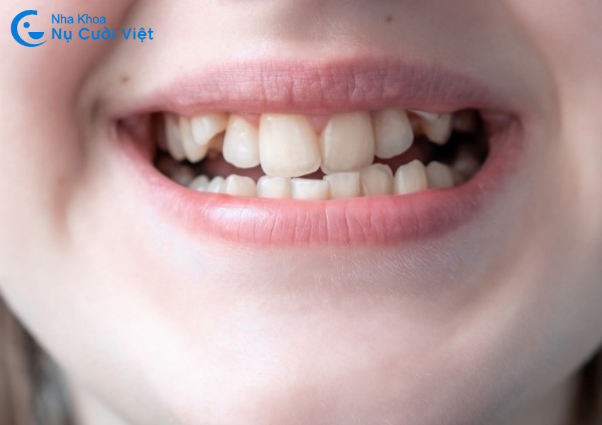 Nụ Cười Việt - Răng mọc lộn xộn thì nên chọn niềng răng hay bọc sứ?