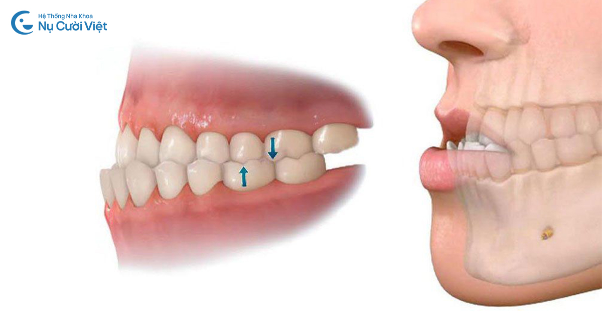 răng bị móm là gì
