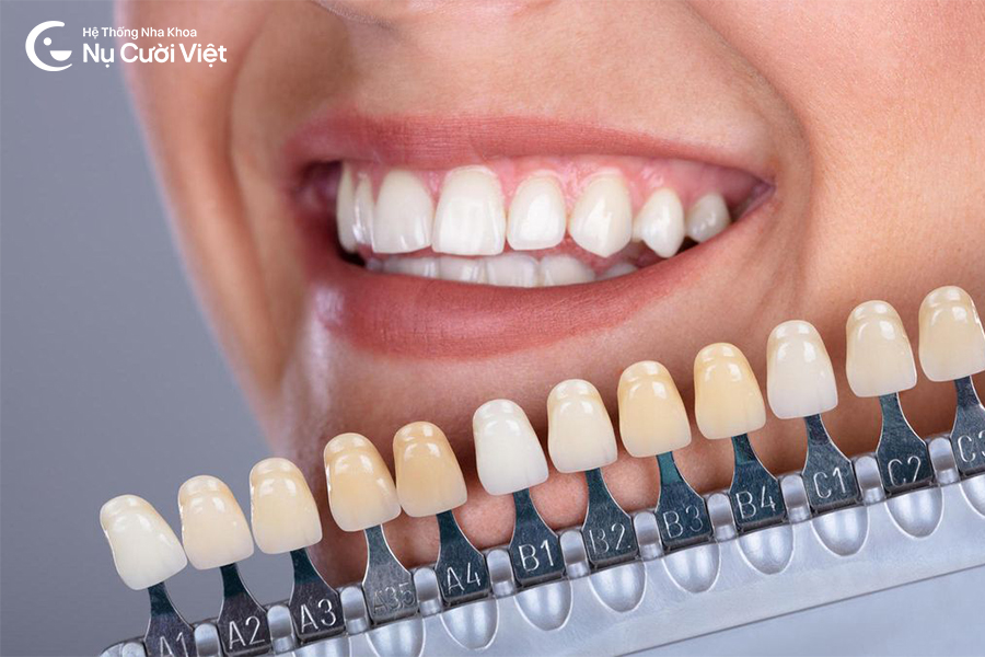 Nụ Cười Việt - LÀM RĂNG SỨ CÓ BỊ XUỐNG MÀU KHÔNG? TIPS GIỮ RĂNG SỨ LUÔN TRẮNG SÁNG, BỀN LÂU