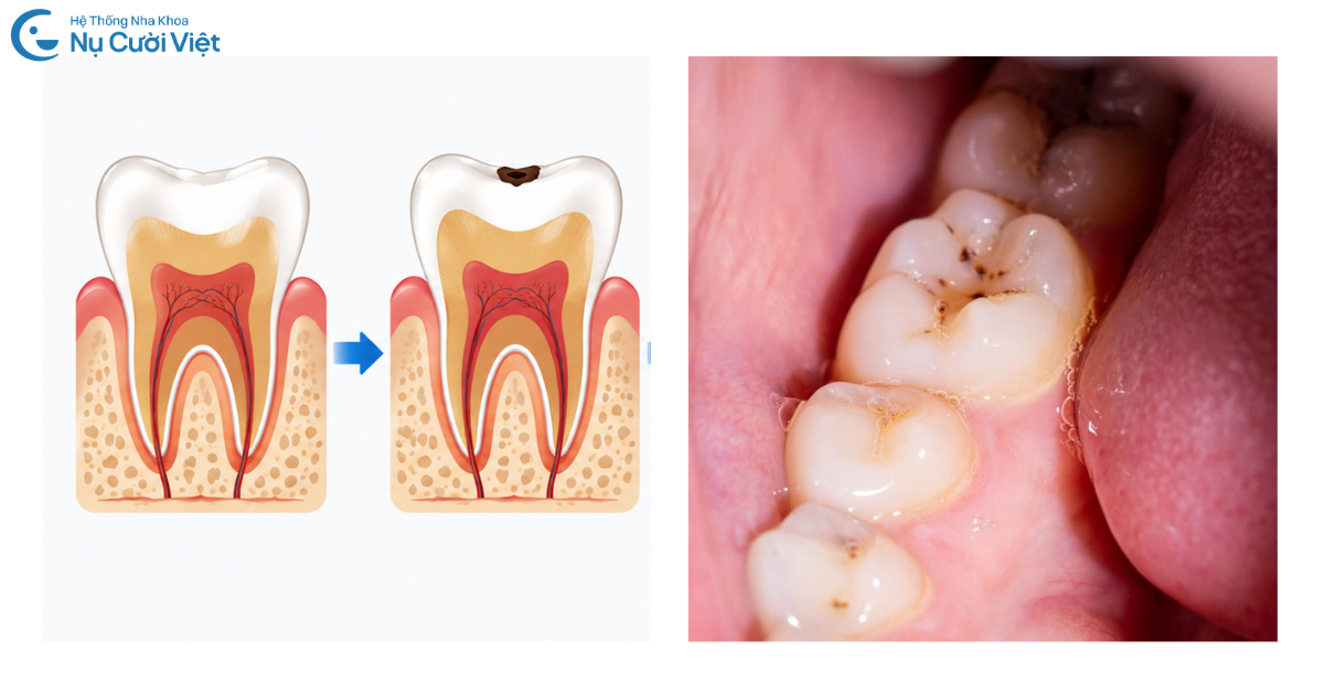 sâu răng mức độ 1