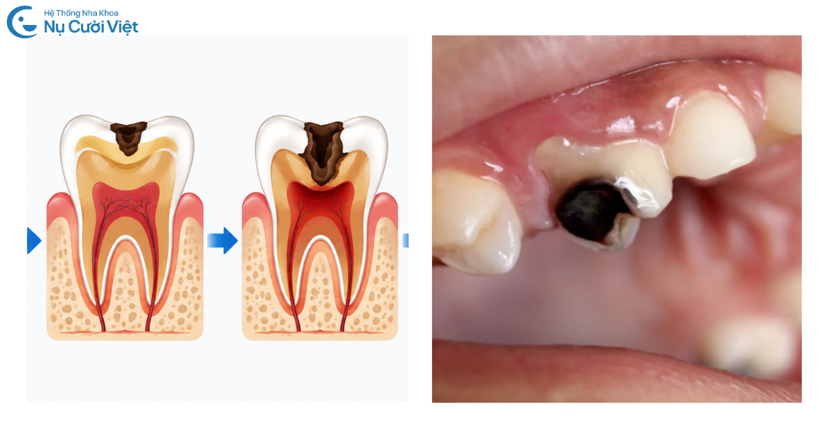 sâu răng mức độ 2