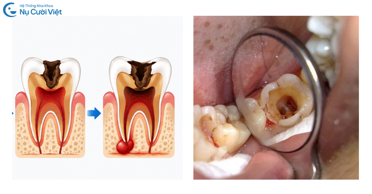 sâu răng mức độ 3