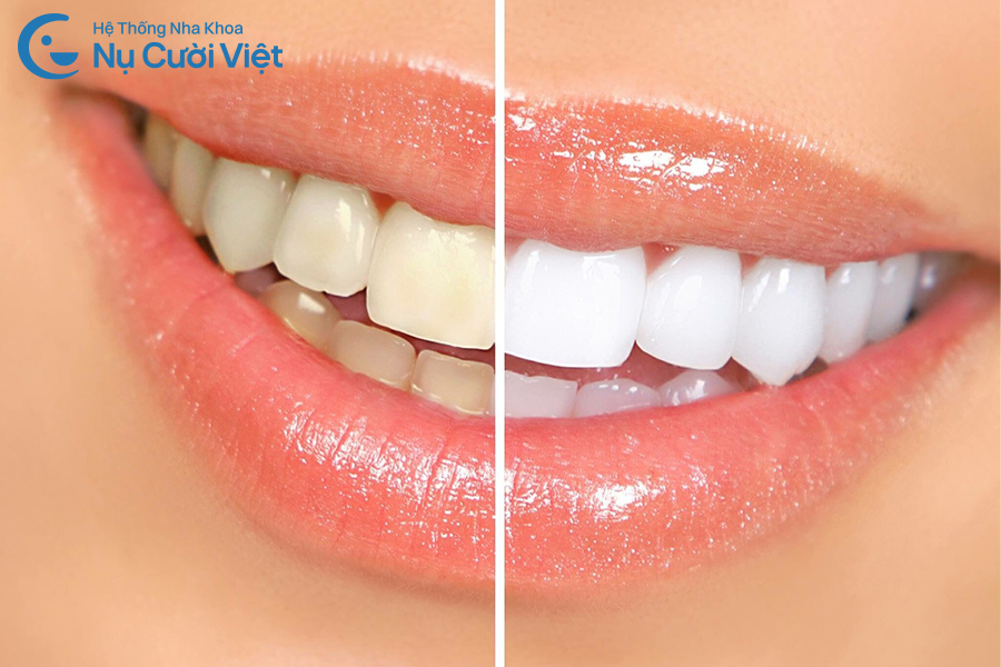 Nụ Cười Việt - Tẩy trắng răng có làm hại đến men răng không? 