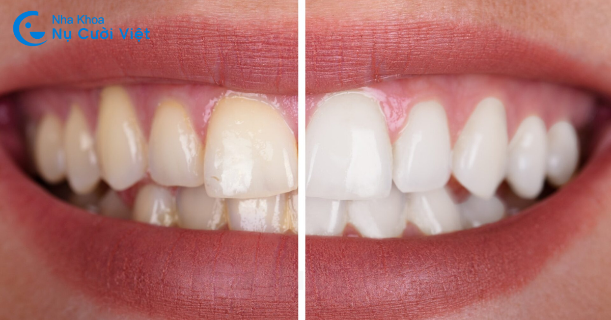 tẩy trắng răng bàng laser