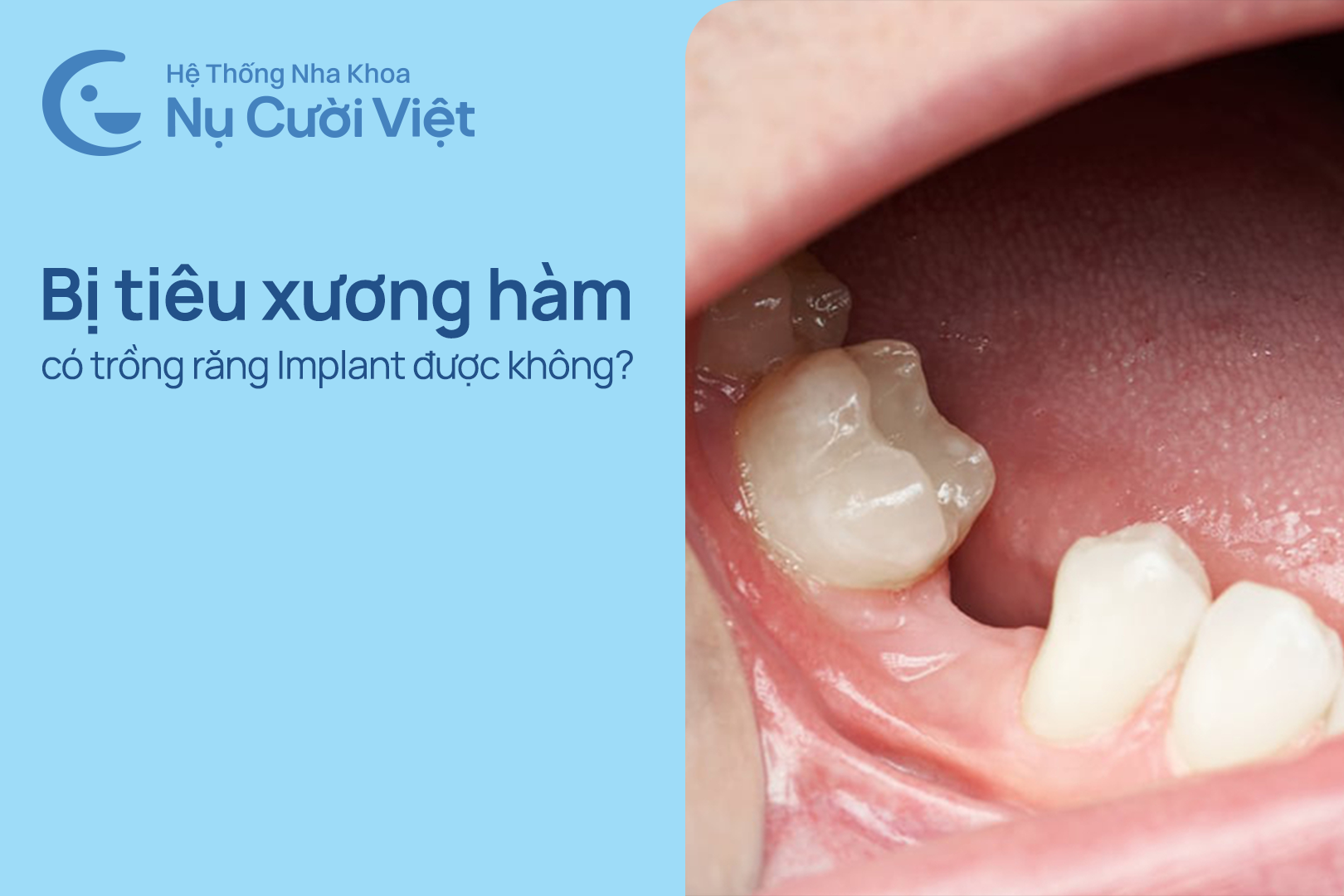 Nụ Cười Việt - Tiêu xương hàm có trồng răng Implant được không?