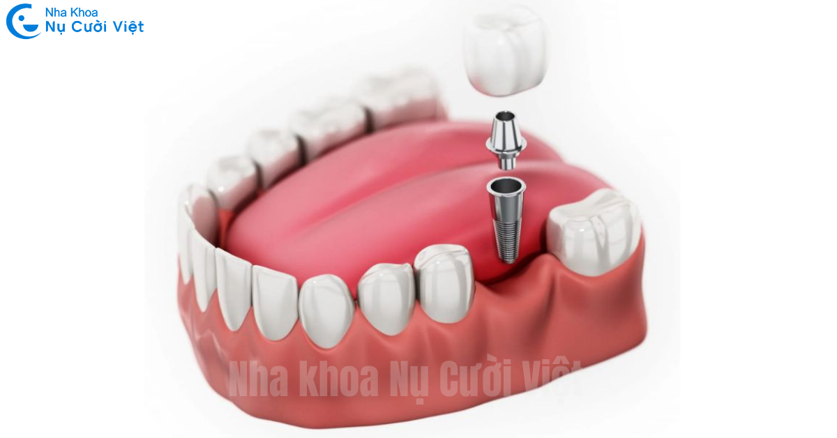 trồng implant răng số 7
