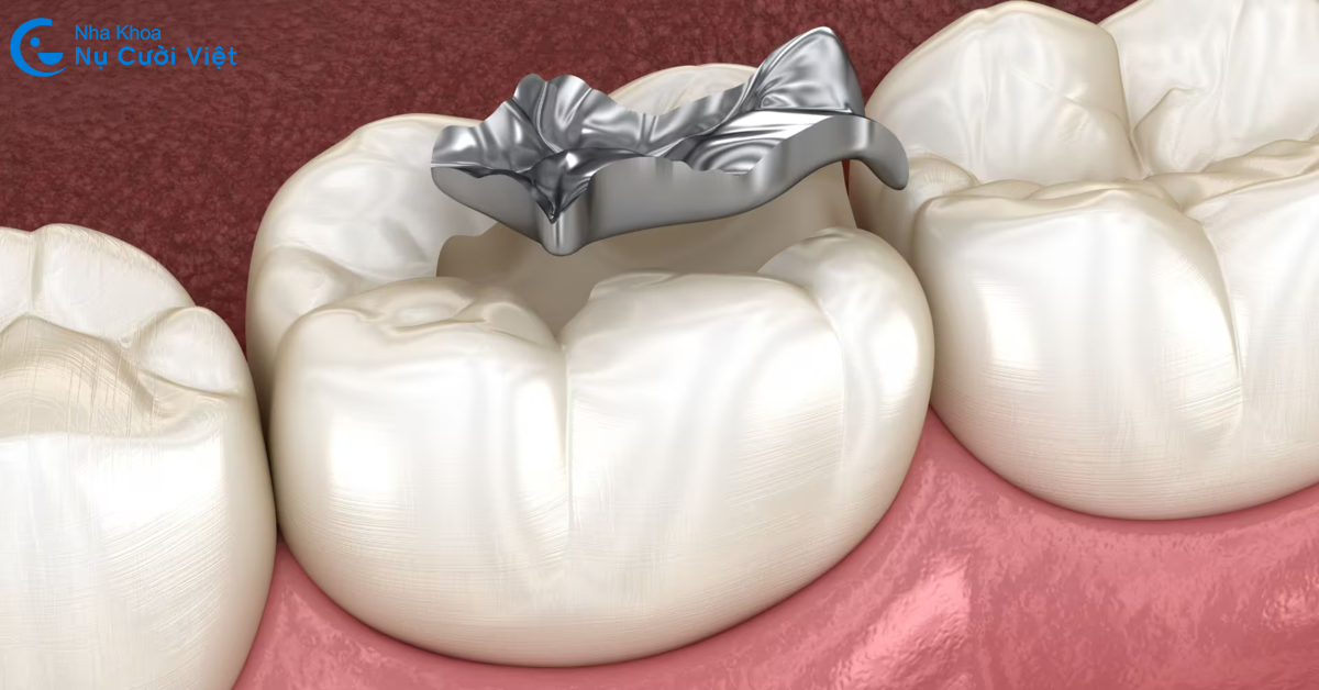 trám răng phục hồi răng hư tổn