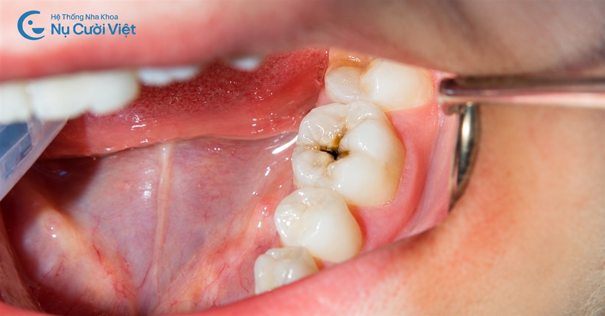 dấu hiệu sâu kẽ răng ở trẻ