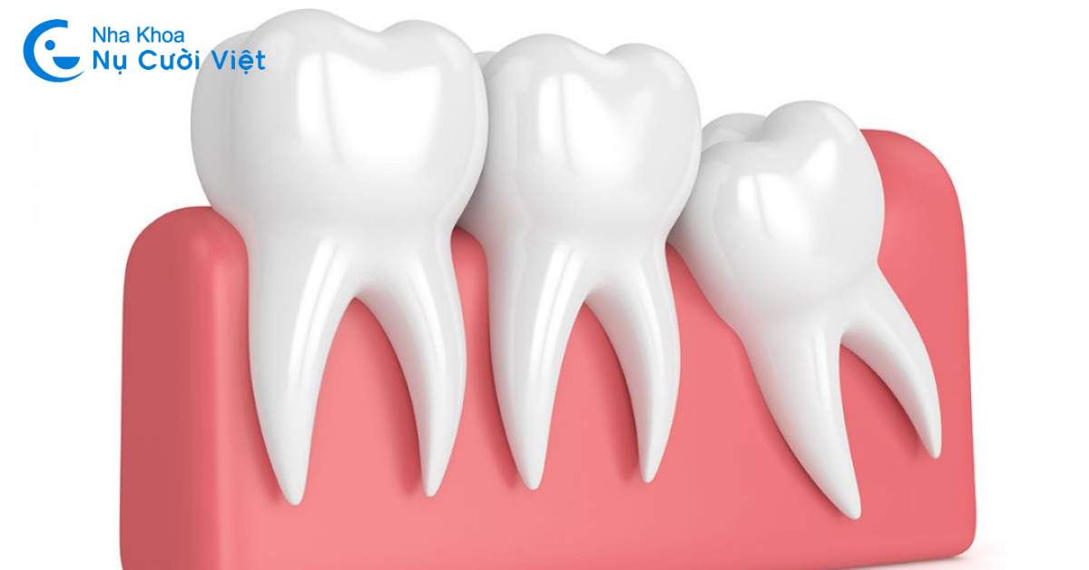 triệu chứng mọc răng khôn là gì