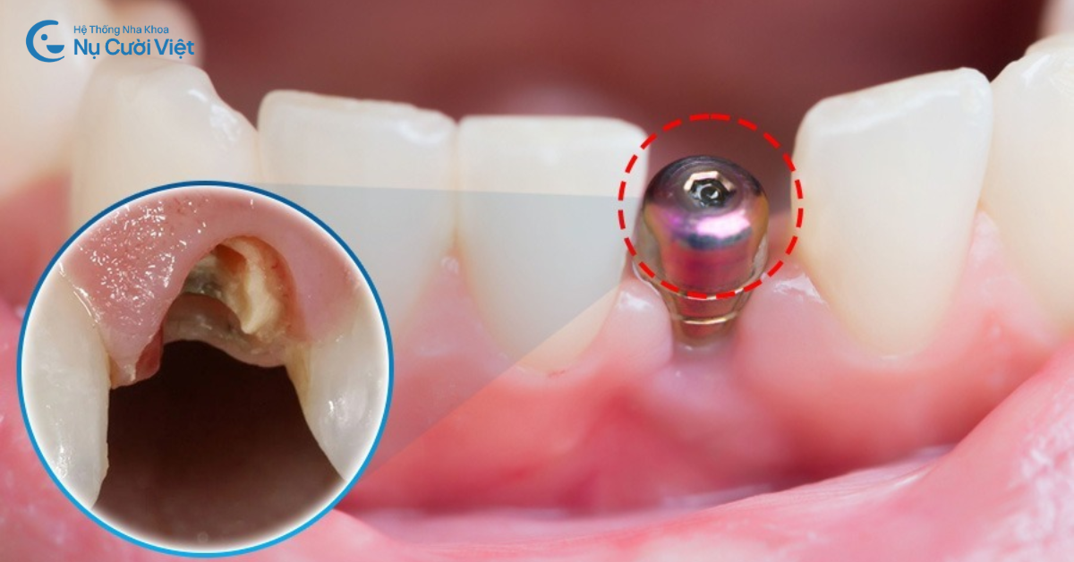 trồng implant răng bị gãy ngang