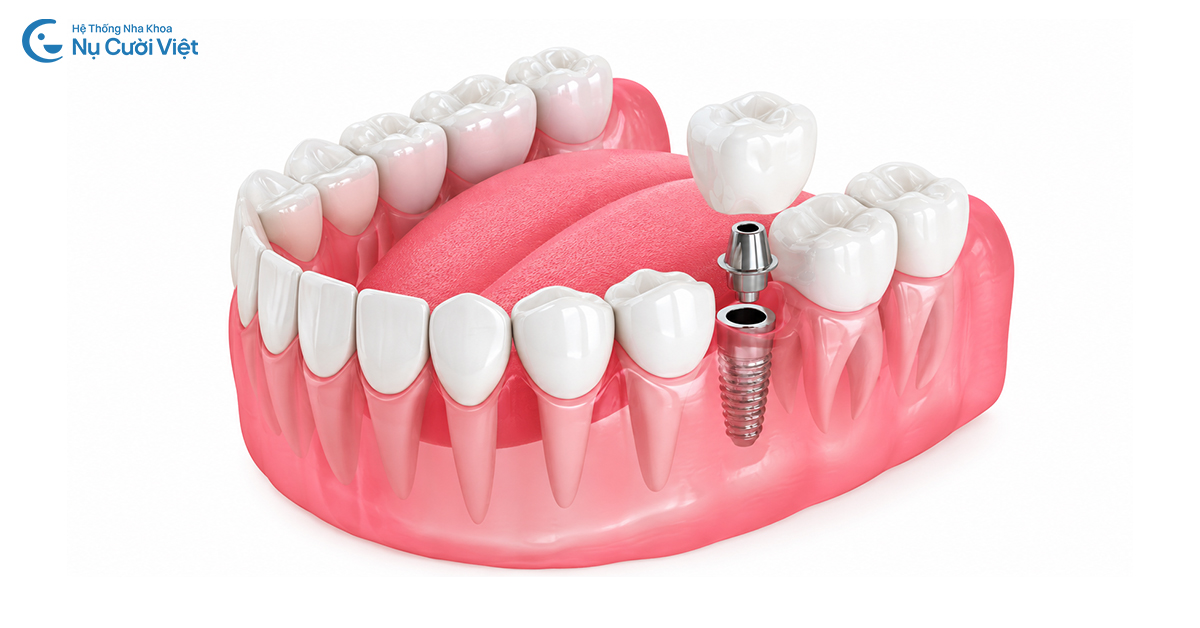 trồng implant răng số 6