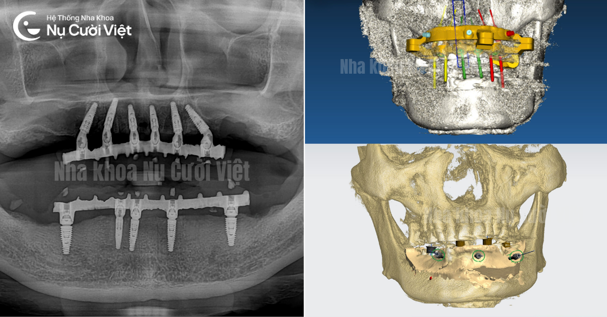 trồng implant toàn hàm có đau không