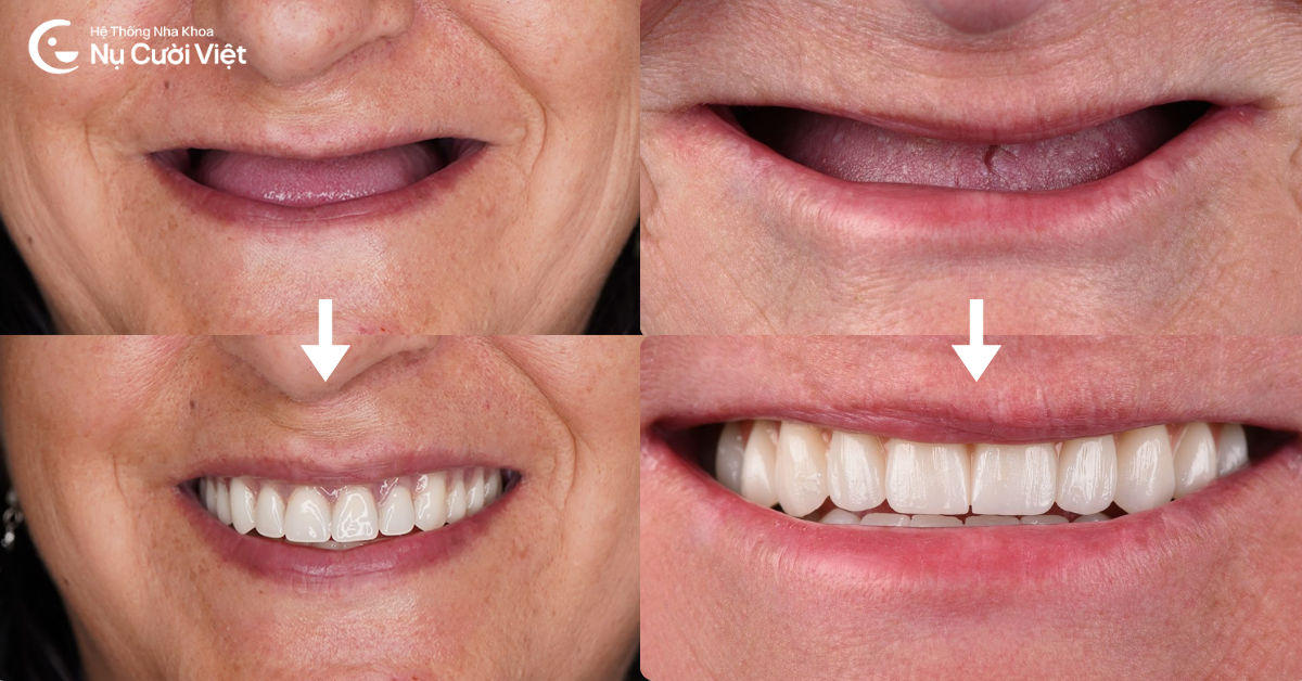 implant phục hồi mất răng