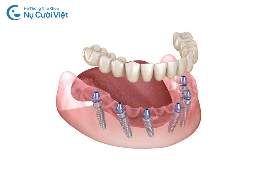 Nụ Cười Việt - Trồng răng toàn hàm có đau không? Công nghệ trồng răng Implant giúp giảm đau, an toàn
