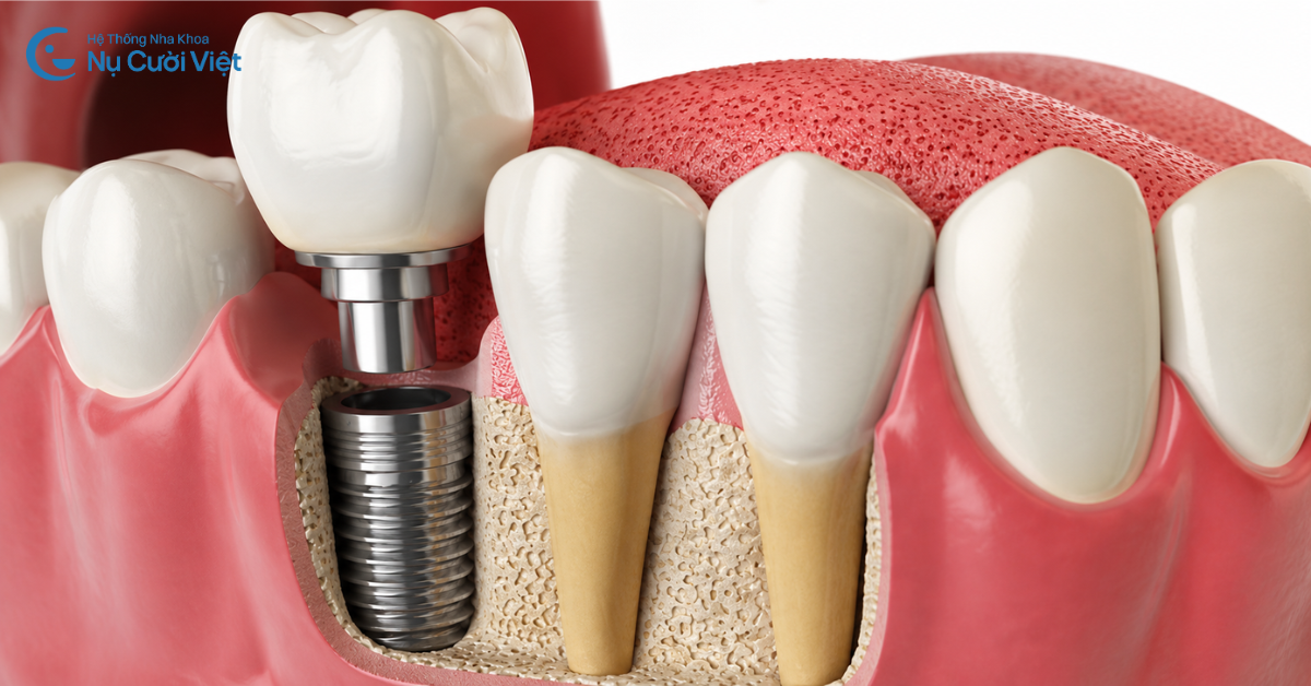 trụ implant lâu ngày có bị gỉ sét không