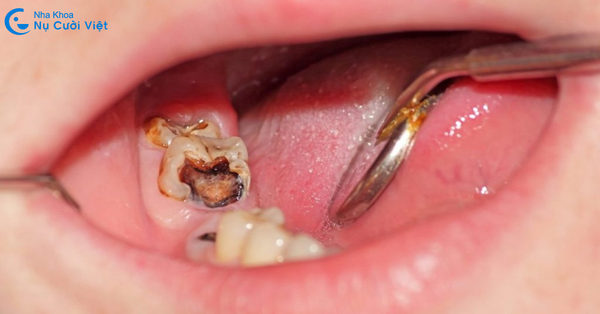những trường hợp nên điều trị tủy
