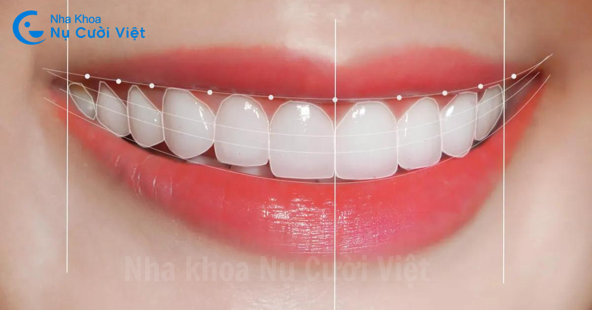 trường hợp nên dán sứ veneer