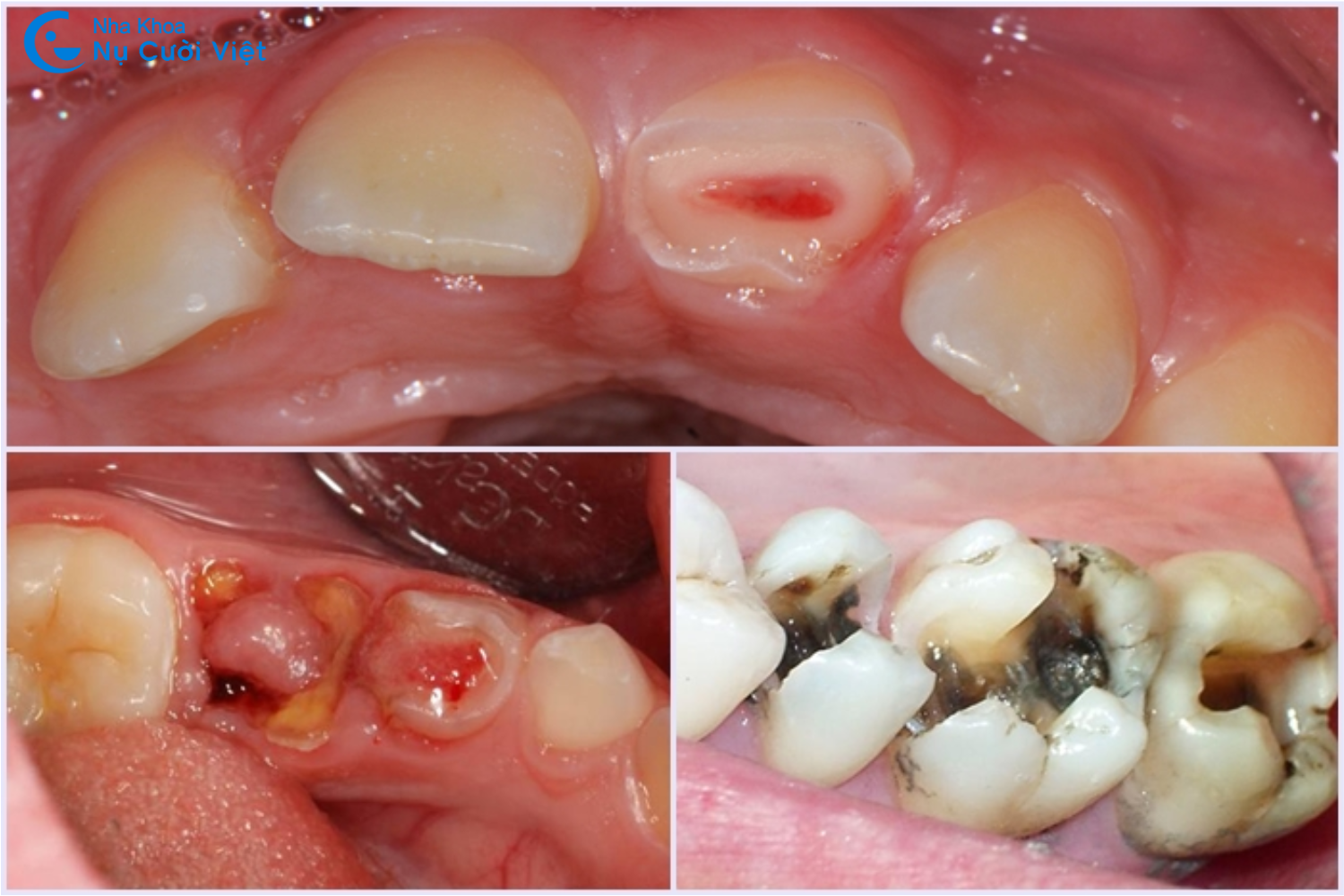 trường hợp nên chỉ định nhổ răng