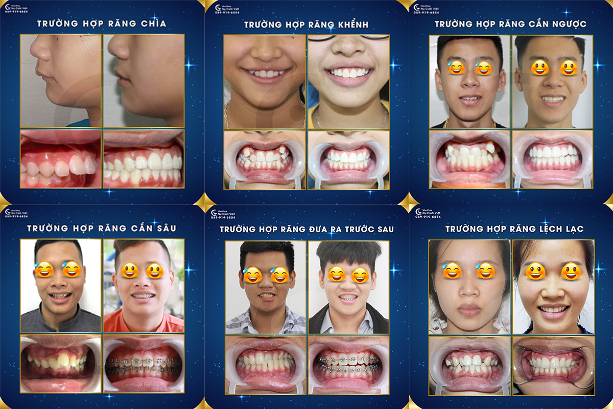 trường hợp niềng răng mắc cài tại Nụ Cười Việt