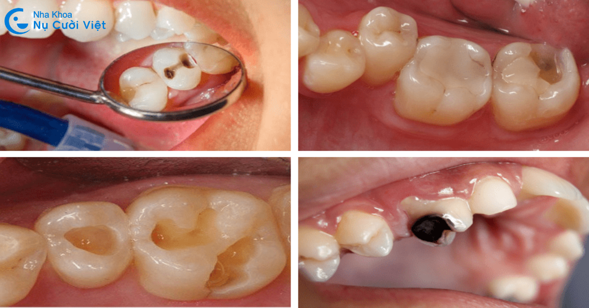 các trường hợp nên trám răng