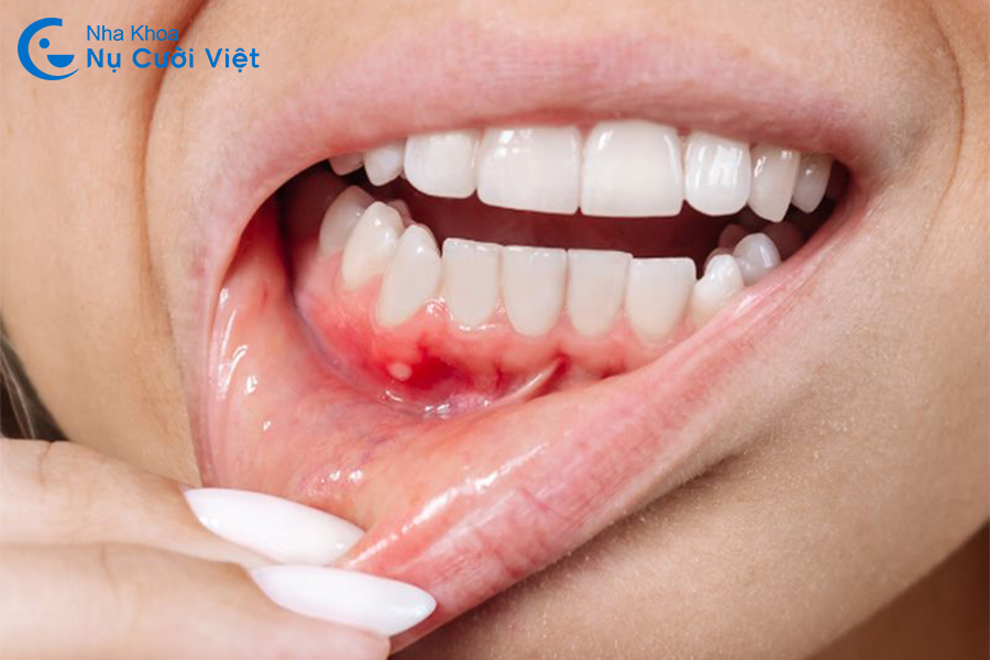 Nụ Cười Việt - Tụt lợi hở chân răng có chữa được không? Dấu hiệu & cách điều trị hiệu quả