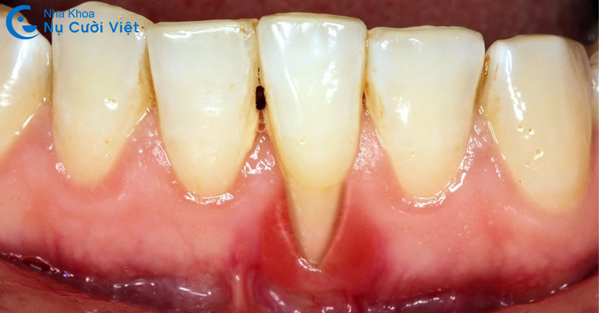 tụt lợi hở chân răng là gì