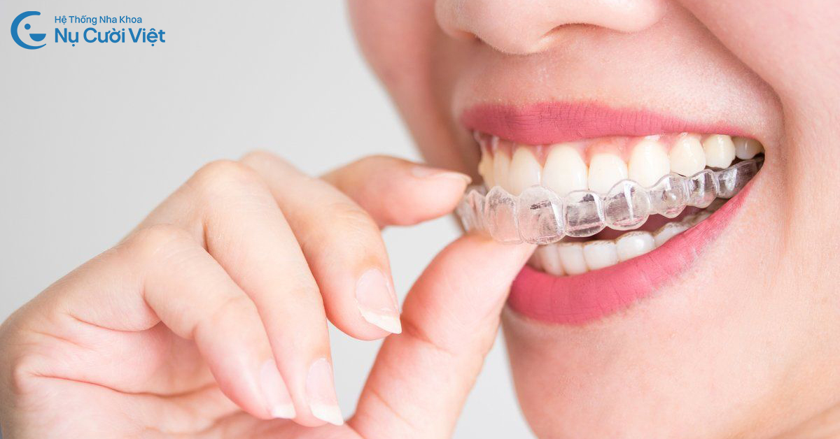 ưu điểm niềng khay trong suốt invisalign